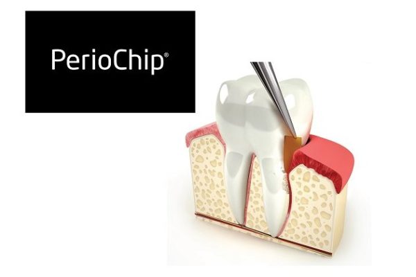 PerioChip – быстрое и эффективное лечение заболеваний десен в стоматологии «Гармония»