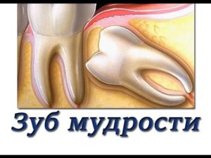 Удаление зубов мудрости. Пять распространенных осложнений и как их избежать